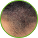 Irritación del cuero cabelludo.